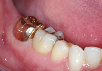 Gold filling on molar tooth