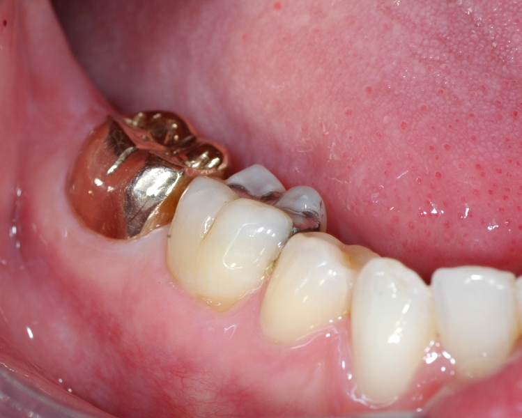 Gold filling on molar tooth