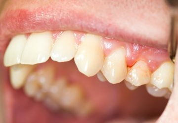 teeth and bleeding gum
