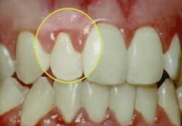 gum disease dentists in brisbane