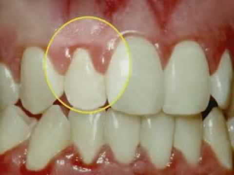 gum disease dentists in brisbane