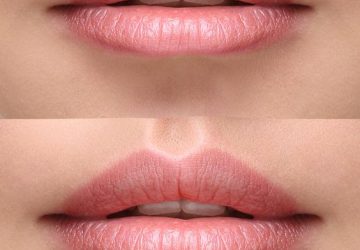 dermal fillers clinic brisbane