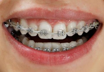 fastbraces vs invisalign