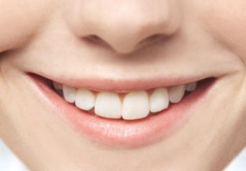 Teeth Whitening Brisbane Dentist