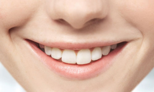 Teeth Whitening Brisbane Dentist