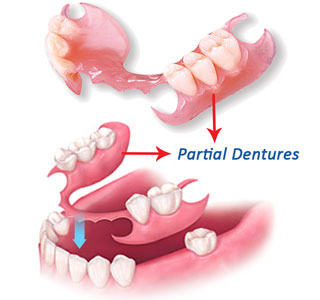 dentures dentist in brisbane