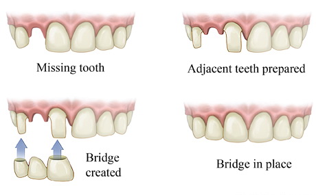graphic of dental bridge