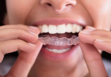 South Brisbane Invisalign greenslopes dental