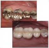 crowns dentists brisbane