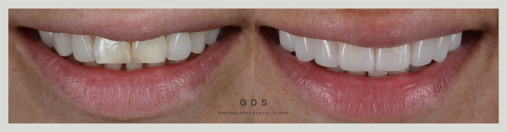Before and after veneers GDS