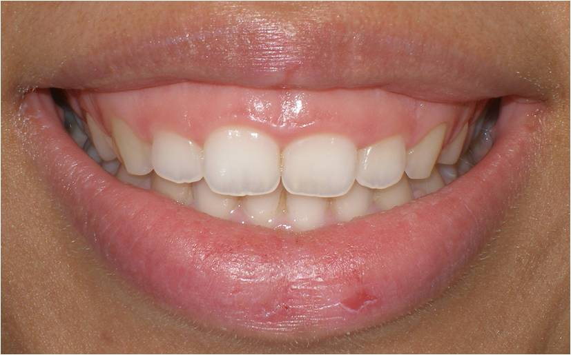 gummy smile dentist brisbane