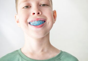 A teenager puts on a training mouthguard for the jaw, close-up. Correction of bite from childhood