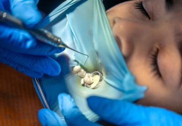 The dentist treats the child's wisdom tooth using a rubber dam. Installing a filling in a tooth.