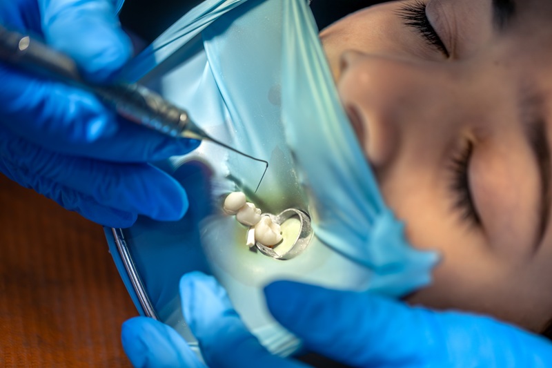 The dentist treats the child's wisdom tooth using a rubber dam. Installing a filling in a tooth.
