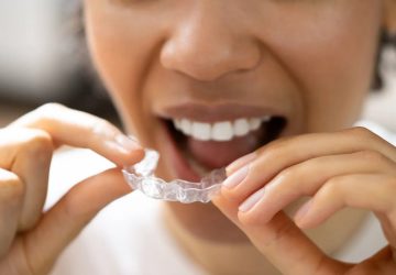can my teen get invisalign?