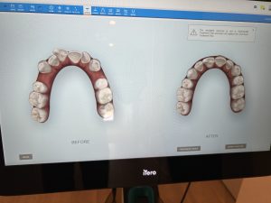 invisalign technology in brisbane