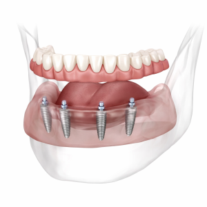 all on 4 implants greenslopes