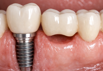 dental implant bridge brisbane