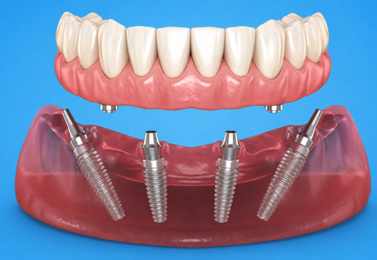 Image sample of an All-on-4 Dental Implants