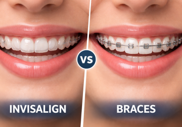 Invisalign vs Traditional Braces