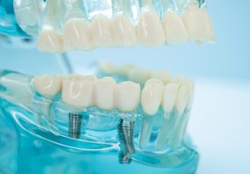 Dental implant, artificial tooth roots into jaw, root canal of dental treatment, gum disease, teeth model for dentist studying about dentistry.