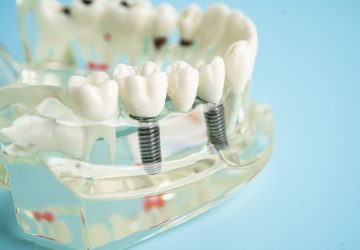 Dental implant, artificial tooth roots into jaw, root canal of dental treatment, gum disease, teeth model for dentist studying about dentistry.