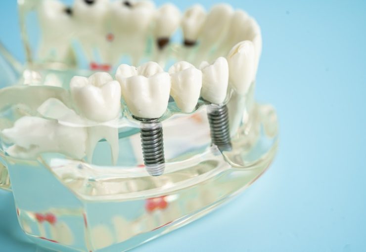 Dental implant, artificial tooth roots into jaw, root canal of dental treatment, gum disease, teeth model for dentist studying about dentistry.