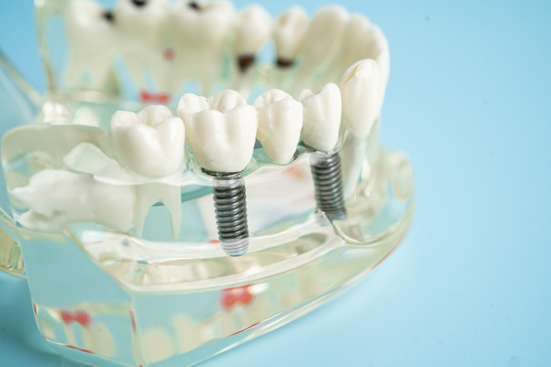 Dental implant, artificial tooth roots into jaw, root canal of dental treatment, gum disease, teeth model for dentist studying about dentistry.