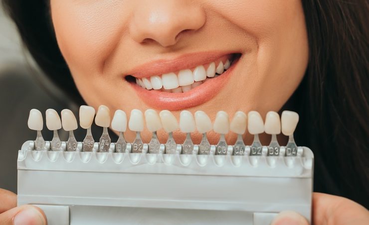 teeth palette with different shades of teeth near female smiling. Stomatology, whitening teeth, tooth implant