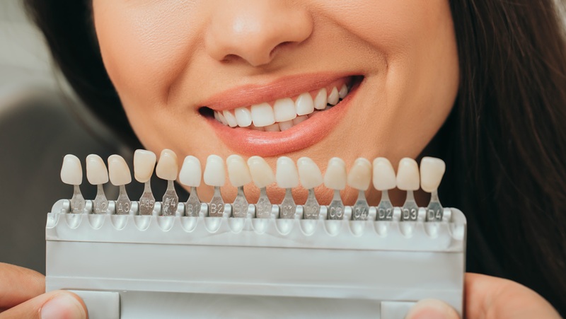 teeth palette with different shades of teeth near female smiling. Stomatology, whitening teeth, tooth implant