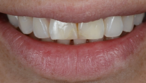 Before(10)