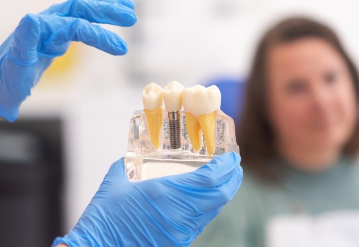 Close-up of dental model with implant. patient of dental clinic on blurred background. dentistry concepts