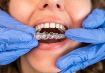 Dentist in gloves applying invisible aligner on female patient teeth at modern clinic. Orthodontic removable straighteners in dentist office. Dental treatment concept.