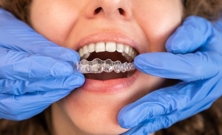 Dentist in gloves applying invisible aligner on female patient teeth at modern clinic. Orthodontic removable straighteners in dentist office. Dental treatment concept.