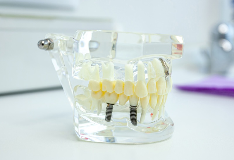Transparent anatomical model of human jaw with dental implants showing inside a dental clinic