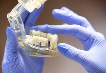 Dentist in blue gloves holding a clear jaw model showing a dental implant screw and abutment, used to explain all on 4 dental implants