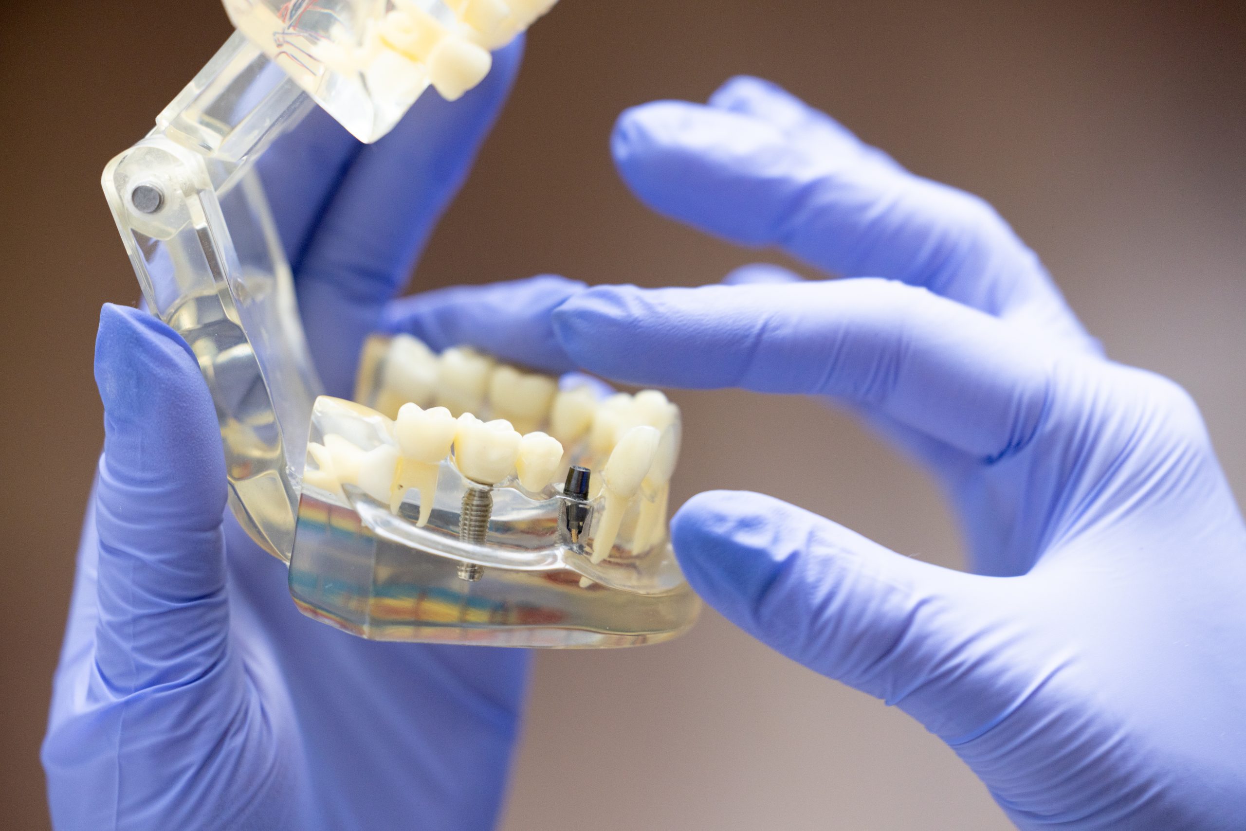 Dentist in blue gloves holding a clear jaw model showing a dental implant screw and abutment, used to explain all on 4 dental implants