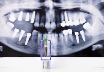 Titanium dental implant model in a clear display holder in front of a panoramic X-ray showing several dental implants, illustrating All-on-4 dental implants.